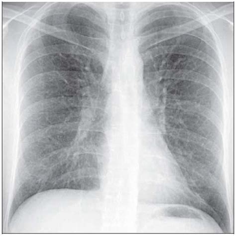 asthma x ray findings|Asthma Imaging and Diagnosis .